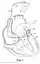 Fig. 02 - Anchor for electrode delivery system