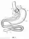 Fig. 02 - Cuff and sleeve system for gastrointestinal bypass