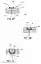 Fig. 06 - Cuff and sleeve system for gastrointestinal bypass