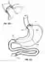 Fig. 07 - Cuff and sleeve system for gastrointestinal bypass