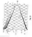 Fig. 08 - Stent assembly