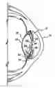 Fig. 01 - Intraocular multifocal lens