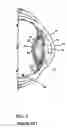 Fig. 02 - Intraocular multifocal lens