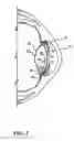 Fig. 06 - Intraocular multifocal lens