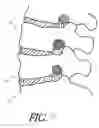 Fig. 12 - Formed in place corpectomy device