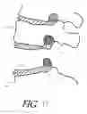 Fig. 13 - Formed in place corpectomy device