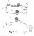 Fig. 14 - Formed in place corpectomy device