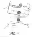 Fig. 15 - Formed in place corpectomy device