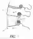 Fig. 16 - Formed in place corpectomy device