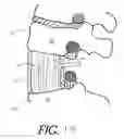 Fig. 17 - Formed in place corpectomy device