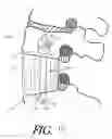 Fig. 18 - Formed in place corpectomy device
