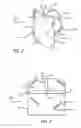 Fig. 03 - Device for UV protection of face while tanning