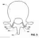 Fig. 06 - Osteogenic implants for soft tissue