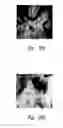 Fig. 43 - Anti-angiogenic compositions and methods of use