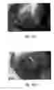 Fig. 76 - Anti-angiogenic compositions and methods of use