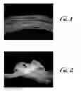 Fig. 02 - Enhanced filamentous silicone products and processes