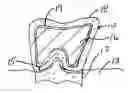 Fig. 01 - Dental crown composed of anodized titanium