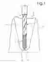 Fig. 02 - Method and drill bit for extracting a root of a tooth