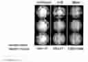 Fig. 11 - Method and means for treatment of osteoarthritis