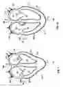 Fig. 02 - CARDIAC SUPPORT DEVICE WITH DIFFERENTIAL COMPLIANCE