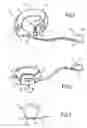 Fig. 02 - Adjustable gastroplasty ring comprising a grip tab