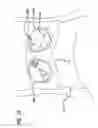 Fig. 30 - Robotic surgical instruments for irrigation, aspiration, and blowing