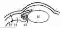 Fig. 01 - Methods and apparatus for presbyopia correction using ultraviolet and infrared lasers