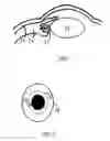 Fig. 02 - Methods and apparatus for presbyopia correction using ultraviolet and infrared lasers