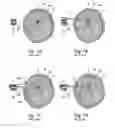 Fig. 02 - Aiming arm hole shaped to perform an incision through, and method to use that same