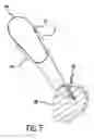 Fig. 07 - Arthoscopic method and apparatus for tissue attachment to bone