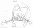 Fig. 02 - System and method for locating resorbable tissue fixation devices