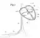 Fig. 02 - System, apparatus, and method for repairing septal defects