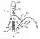 Fig. 01 - Apparatus and method for manipulating stomach tissue and treating gastroesophageal reflux disease