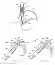 Fig. 08 - Apparatus and method for manipulating stomach tissue and treating gastroesophageal reflux disease