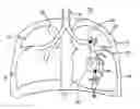 Fig. 01 - Occlusion device