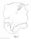 Fig. 04 - Subcutaneous tunneller