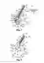 Fig. 04 - Implantation of a deformable prosthesic device