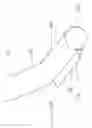 Fig. 16 - Infra-epidermic subcision device for blunt dissection of sub-epidermic tissues