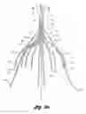 Fig. 04 - Removable vena cava filter having inwardly positioned anchoring hooks in collapsed configuration