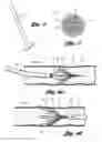 Fig. 06 - Removable vena cava filter having inwardly positioned anchoring hooks in collapsed configuration