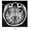 Fig. 08 - Method of treating depression, mood disorders and anxiety disorders using neuromodulation