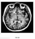 Fig. 09 - Method of treating depression, mood disorders and anxiety disorders using neuromodulation