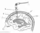Fig. 01 - Central nervous system cooling catheter