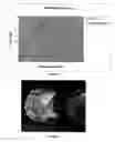 Fig. 02 - Stentless aortic valve replacement with high radial strength