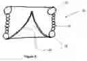 Fig. 04 - Stentless aortic valve replacement with high radial strength