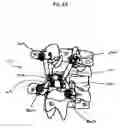 Fig. 07 - Non-linear artificial ligament system