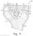 Fig. 07 - Tibial insert and associated surgical method
