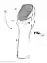 Fig. 06 - Hip stem for receiving intramedullary nail