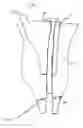 Fig. 08 - Hip stem for receiving intramedullary nail