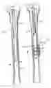 Fig. 12 - Hip stem for receiving intramedullary nail